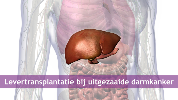 Levertransplantatie bij uitgezaaide darmkanker